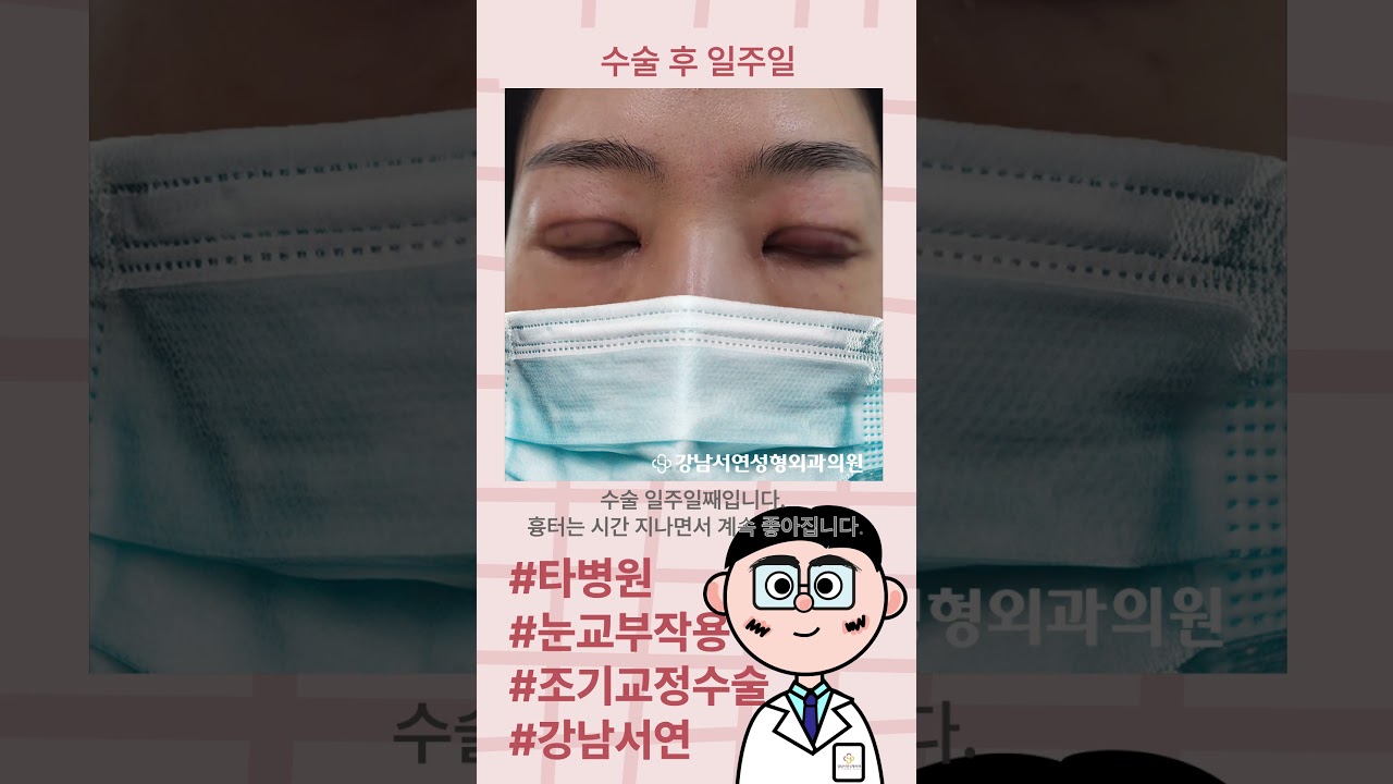 [Ганнам Соён гоо сайхны мэс заслын эмнэлэг] Ганнам Соён: Бусад эмнэлэгт хийсэн нүдний хэлбэр заслын гаж нөлөөг эрт засварласны нэг долоо хоногийн өмнө ба хойно.
