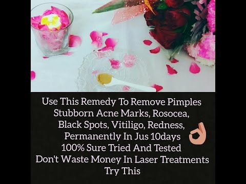 How to remove acne marks,Pimples permanently in jus days %|Rosacea|skincan|vitiligo|Black spots