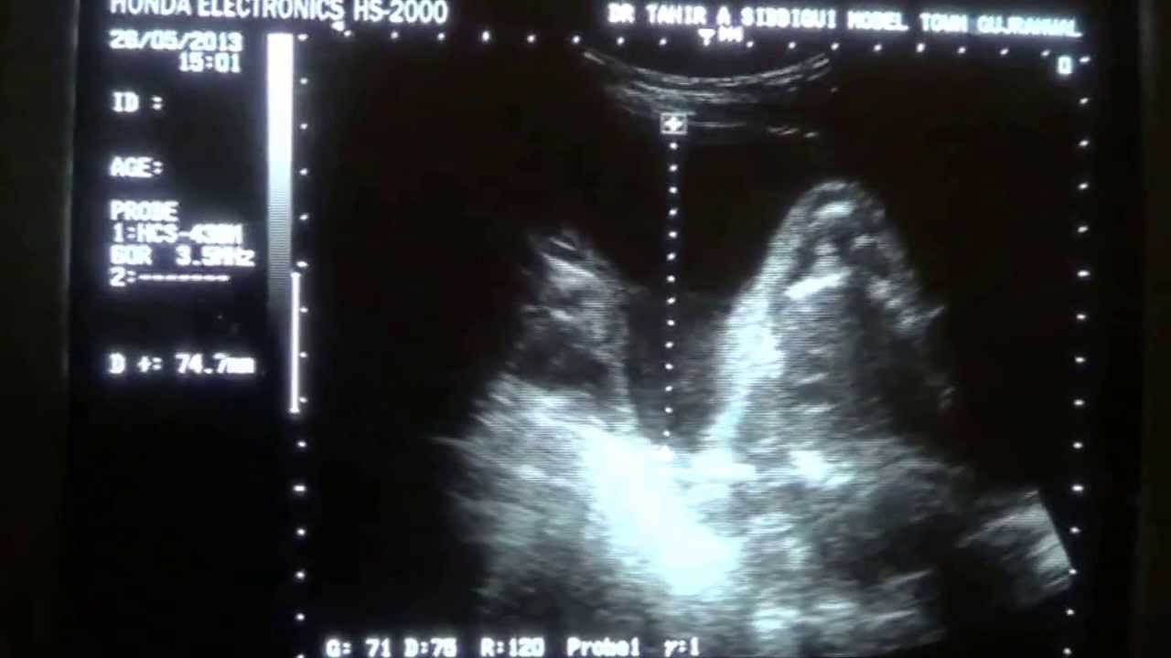 Amniotic Fluid Index Chart For Ultrasound