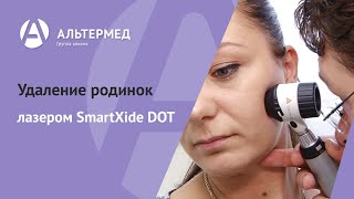 Альтермед. Удаление родинок лазером SmartXide DOT(Быстрое, безопасное и безболезненное удаление родинок, папиллом, бородавок и других доброкачественных..., 2015-01-29T09:17:00.000Z)