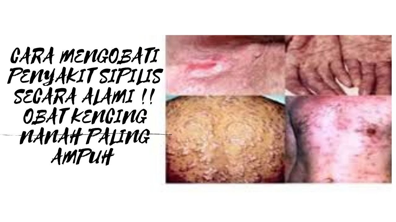 Cara Mengobati Penyakit Sipilis Secara Alami !! Obat Kencing Nanah