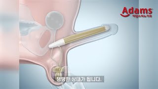 [아담스비뇨기과] 한번 수술로 평생 사용가능한 팽창형 보형물 수술의 작동 원리는?