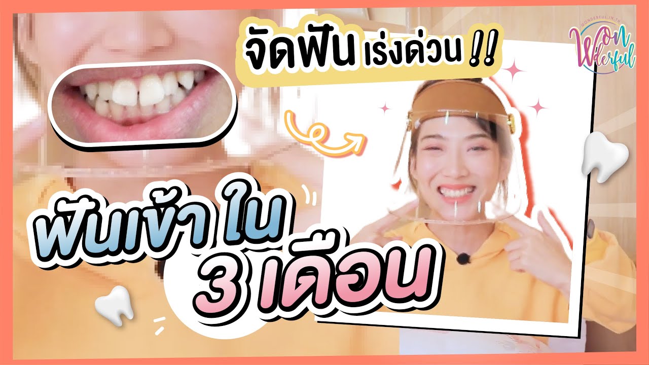 รีวิวพลีชีพ จัดฟันเร่งด่วนแบบไม่ต้องถอน ฟันเข้าภายใน 3 เดือน [Time Fun dental clinic]