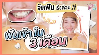 รีวิวพลีชีพ จัดฟันเร่งด่วนแบบไม่ต้องถอน ฟันเข้าภายใน 3 เดือน [Time Fun dental clinic]