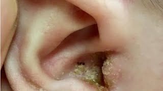 耳掃除の難聴 最大の耳垢除去 | T7H79