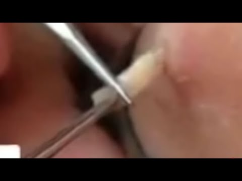 Best Pimple Popper Tools & Cyst Acne Treatment 