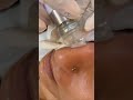 ✨Hydrafacial✨💧Cleanse💧Exfoliate 💧Hydrate