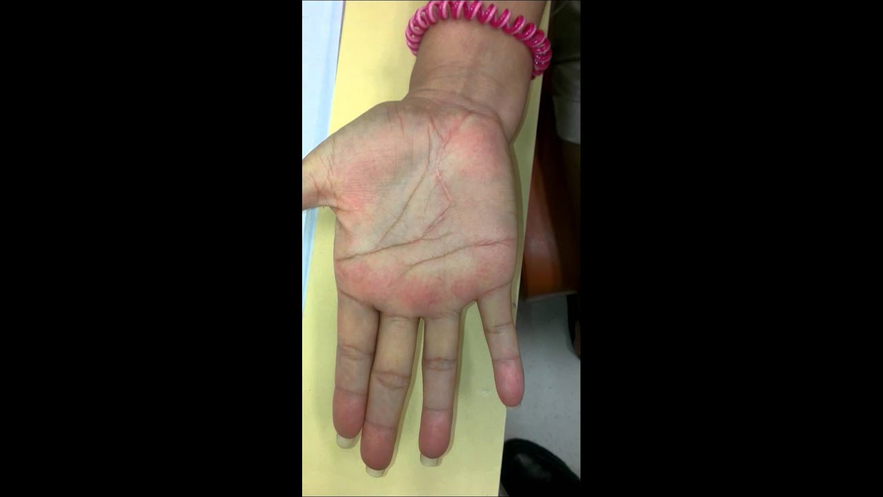 Post Op For Lump In Palm Youtube