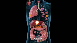 From Stage 0 To Stage IV: The Complete Cancer Staging Guide