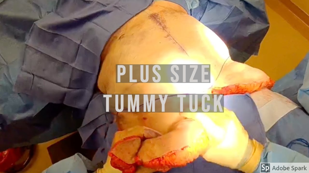 plus size hourglass tummy tuck plus size hourglass tummy tuck