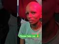 #alopecia#hairloss#hair#viral#ytshorts#hairdamge#hairregrowth#shorts