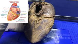 Blood supply of heart or Coronary circulation - Gross and clinical anatomy screenshot 4