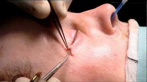 Sharon's facelift - 10 Years Younger