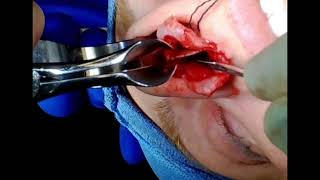 Preservation rhinoplasty. High septal strip cartilage-only pushdown, piezo assisted, open technique