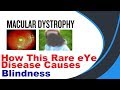 Macular Dystrophy (hindi)