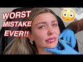 Getting ALL of my LIP FILLER DISSOLVED *SCARY TRANSFORMATION*