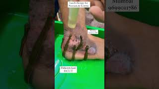 Leech therapy for Eczema treatment, 100% results kzhijama leechtherapy leech trending treatment