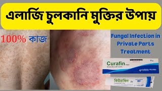 Dad Fungal Infection Treatment | Fungal Infection in Private Parts Treatment | Dad Allergi Treatment