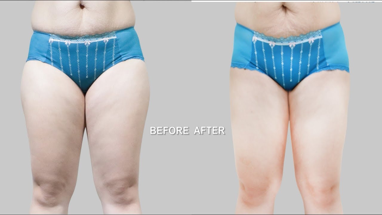 水刀抽脂手術大腿精雕術後全紀錄 淨妍醫美 Youtube