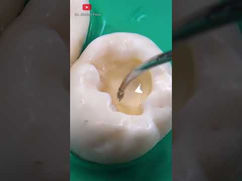 Vídeo: Com controlar la caries a les dents?