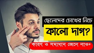 ছেলেদের চোখের নিচের কালো দাগ হওয়ার কারণ এবং রাতারাতি মুক্তির উপায়? Remove Dark Circles Bangla