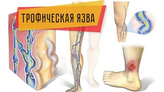 Трофическая язва