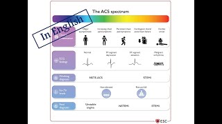 1. Diagnosis & Triage of ACS (English Version)