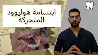 إبتسامة هوليوود المتحركة أو السناب اون Hollywood Smile??