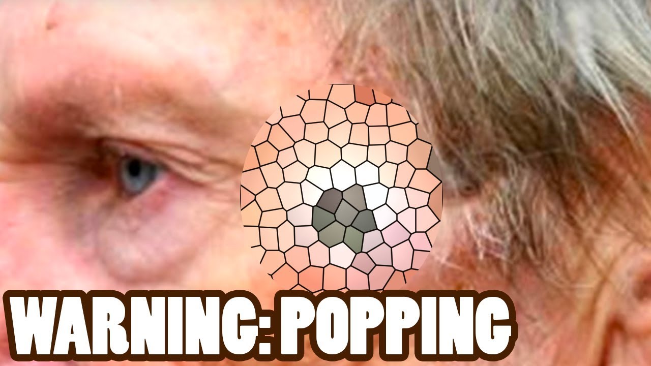 Top 3 Dilated Pores of Winer & Blackheads Ever YouTube