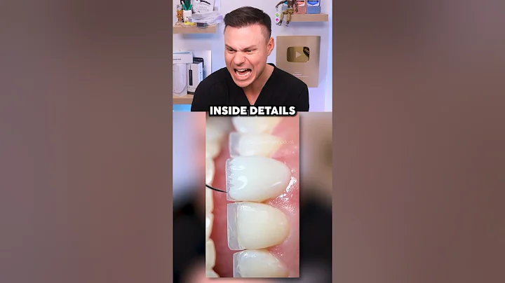 Dentist Reveals What REAL Professional Veneers Look Like! 😁🦷
