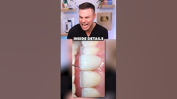 Dentist Reveals What REAL Professional Veneers Look Like! 😁🦷