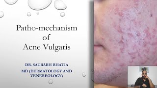 Patho-mechanism of Acne Vulgaris