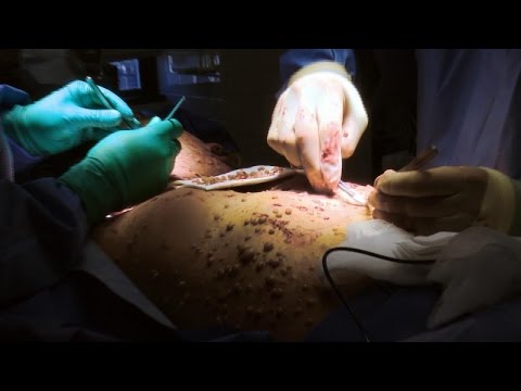 Woman Covered in Tumors Undergoes Surgery