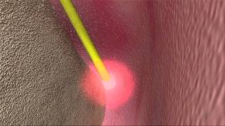 Laser Periodontal Therapy - WPT™ Animation