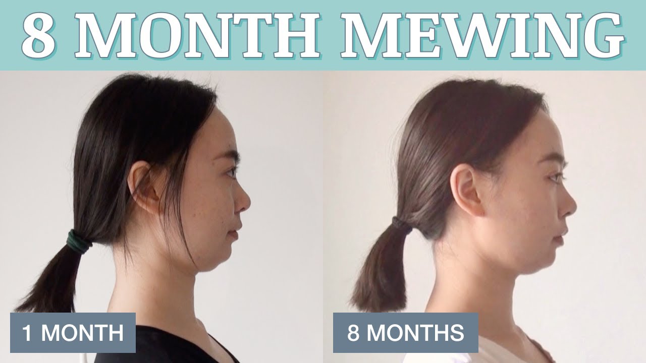 4 Months Mewing Before & After at Age 28 