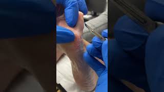 Watch How An Aussie Podiatrist Tackles A Cluster Of Painful Corns! #Footcare #Podiatry #Healthtips