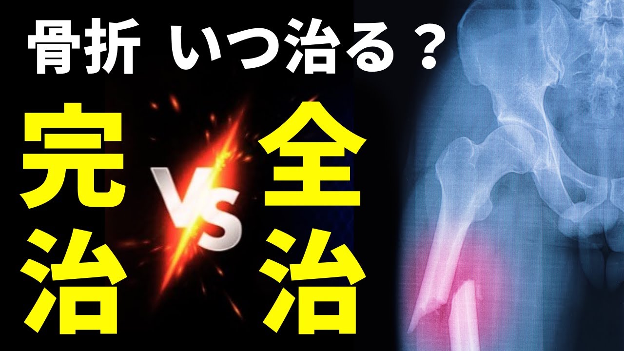 【骨折が治るまで】骨折はいつ治る？全治は治ってない。骨折後の全治と完治は違う！
