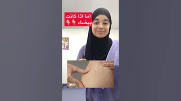 هل يوجد علاج لع لامات تمدد الجلد 