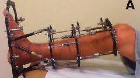 Taylor Spatial Frame; external fixator in orthopedic surgery to correct complex limb deformities