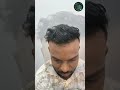 Hair Transplant Before & After | Real Transformation by Dr. Sameer Pundeer