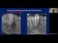 Periapical Lateral lesion healing