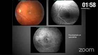 AIOC2021-GP162-Topic -Dr.GUPTA SALIL- FFA in Diabetic Retinopathy