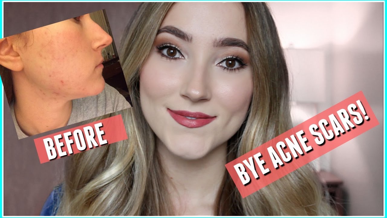 How I Cleared My Acne Scars FOR GOOD! - YouTube