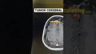TUMOR CEREBRAL: TRATAMENTO COM RADIOCIRURGIA