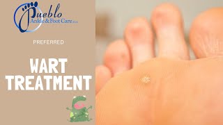 How we treat warts at Pueblo Ankle and Foot Care | Benjamin Marble DPM