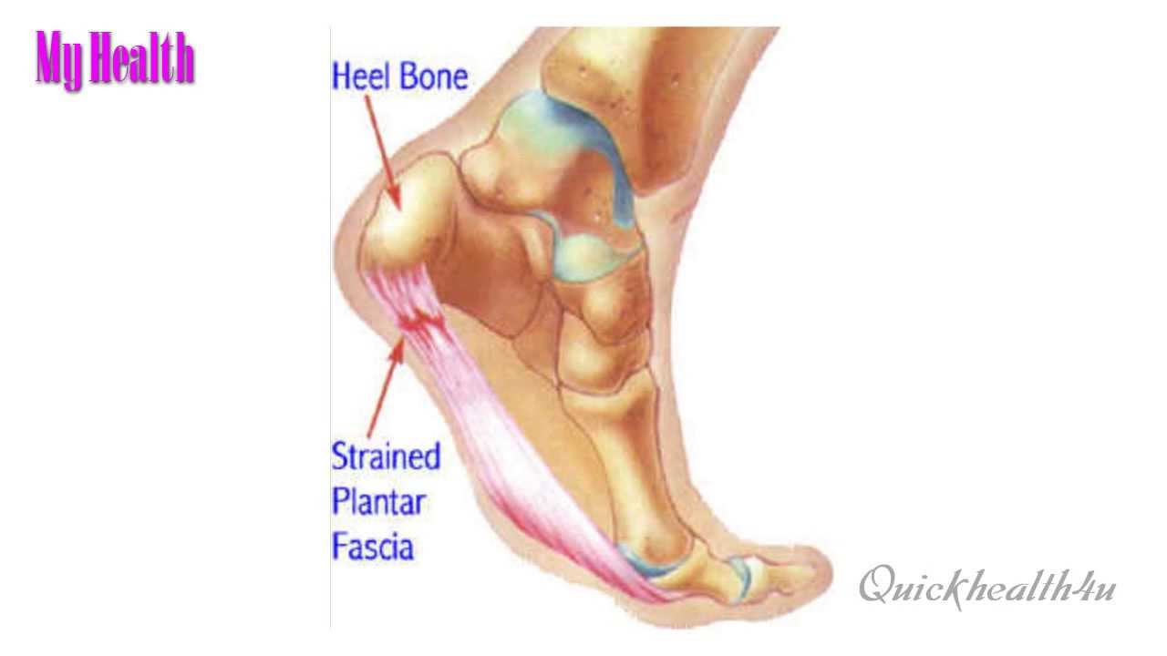 Почему болит правая пятка внутри. Плантарный фасциит стопы. Фасциит пяточной кости.