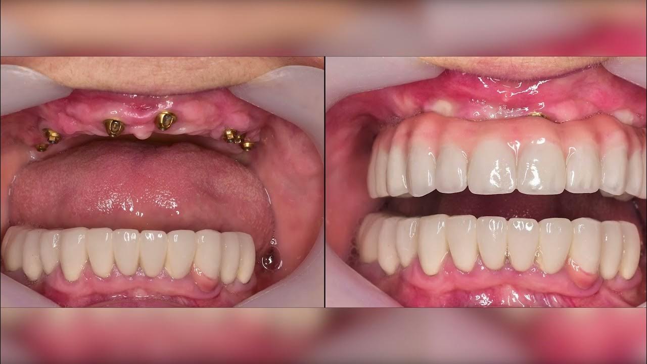 Dental Implant YouTube