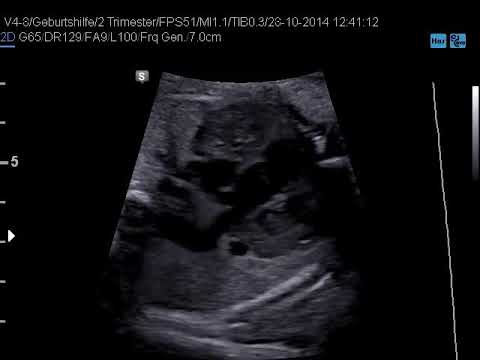 Persistent left superior vena cava - YouTube