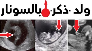جنين ذكر بالسونار الحمل بولد في السونار الحمل بذكر  جنين ولد (ذكر) دكتور يوسف عيد DR YUSSIF EID 2024