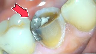 Dental Crown Procedure { Zirconia Crown Preparation w/ Microscope } by Smile Influencers 14,698 views 1 year ago 8 minutes, 6 seconds